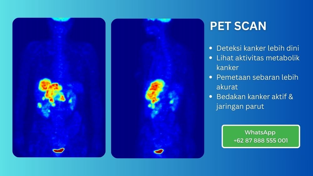 Radioterapi Beacon Hospital